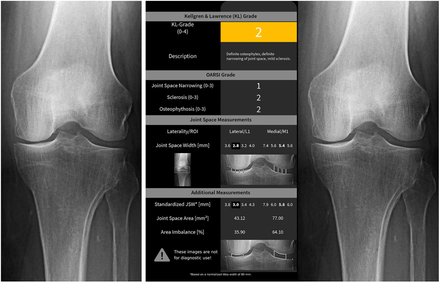 Automated Knee Osteoarthritis Assessment Increases Physicians